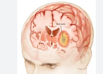 वीर अस्पतालमा ब्रेन ट्युमरको निःशुल्क शल्यक्रिया