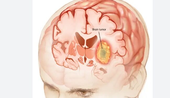 वीर अस्पतालमा ब्रेन ट्युमरको निःशुल्क शल्यक्रिया