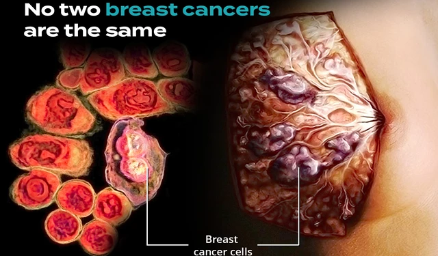 स्तनपान नगराउने महिलालाई स्तन र डिम्बासयको क्यान्सरको जोखिम बढ्दो