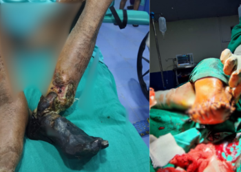 सोलुखुम्बुमै पहिलो पटक सोताङमा खुट्टा काटेर शल्यक्रिया 