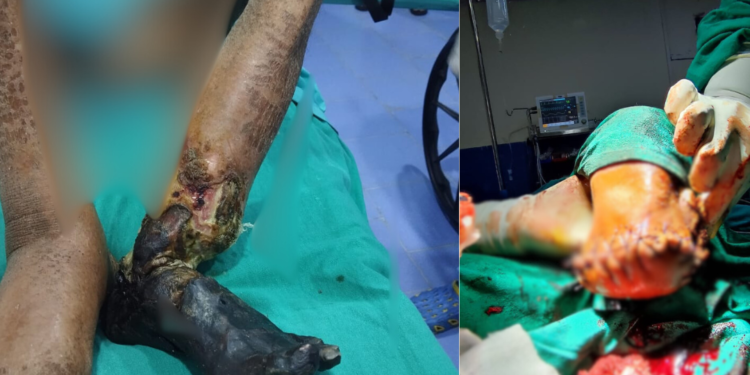 सोलुखुम्बुमै पहिलो पटक सोताङमा खुट्टा काटेर शल्यक्रिया 