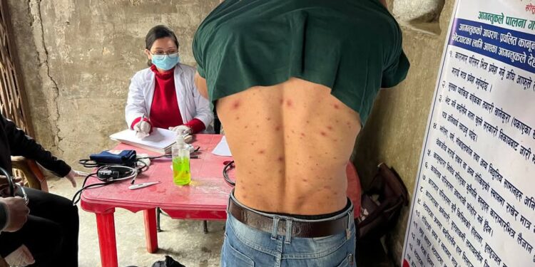 सोलुका कैदीबन्दीमा देखियो ठेउला संक्रमण, २८ जनाको उपचार